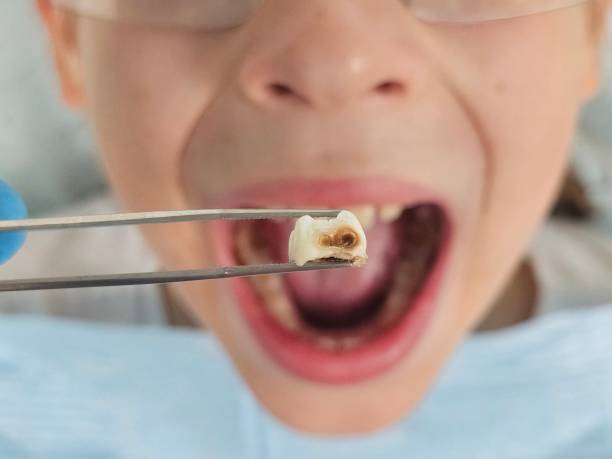 Best Emergency Treatment for Dental Infections or Abscesses in Merrimac, VA