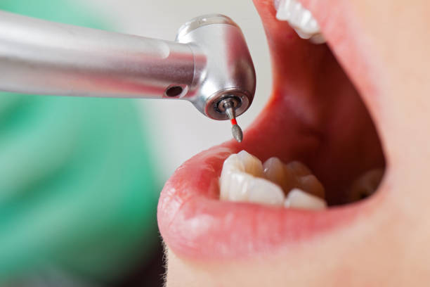 Best Emergency Wisdom Teeth Removal in Merrimac, VA